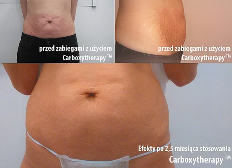 Karboksyterapia - efekty przed i po