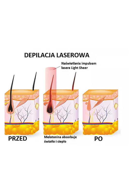 lightsheer- efekty po zabiegu depilacji laserowej