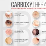karboksyterapia-efekty